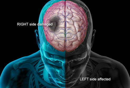 Jangan Putus Asa, Pasien Stroke Disarankan Tetap Terapi Seumur Hidup